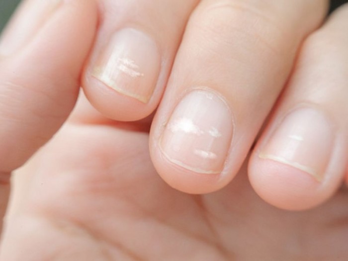 Стало відомо, на які небезпечні порушення можуть вказувати білі смужки на нігтях