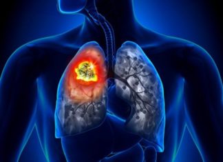 Медики пояснили, чому рак легенів може виникнути у некурящих людей