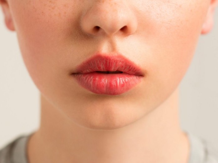 Про які проблеми зі здоров'ям говорить суха шкіра губ