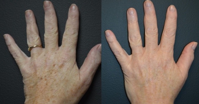 pico.genesis.before.after_.hand_.brown_.spots_.stamford.ct_.