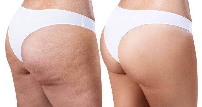 get-rid-of-cellulite-with-these-easy-and-effective-home-remedies