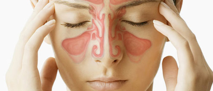 sinusitis