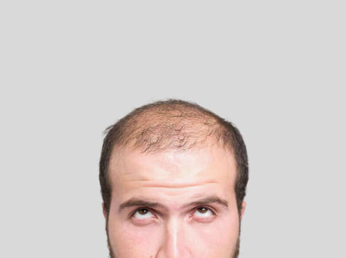 Alopecia