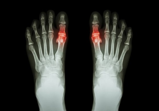 gout1-557x387