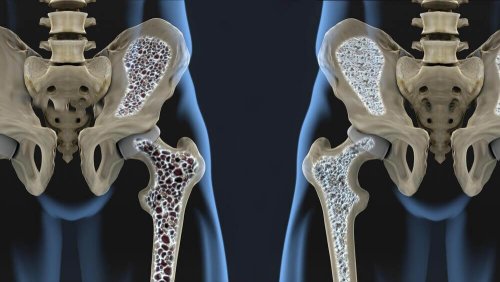 osteoporoz-1-e1534274734161