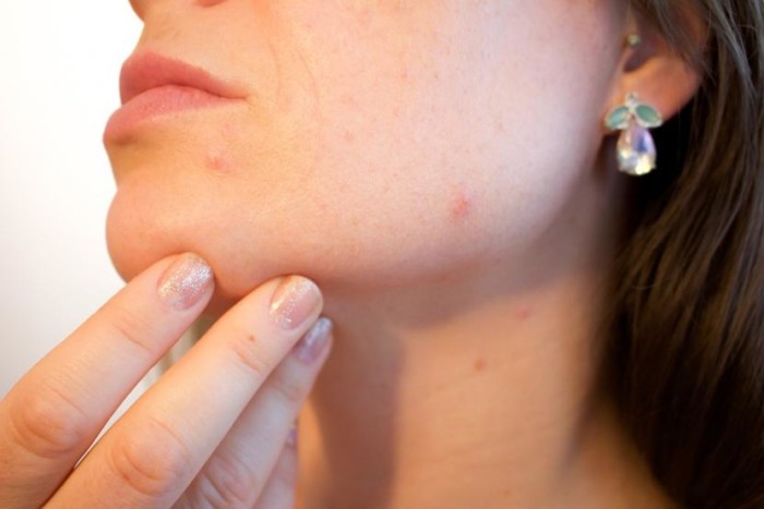 1549301428_acne-1606765_960_720