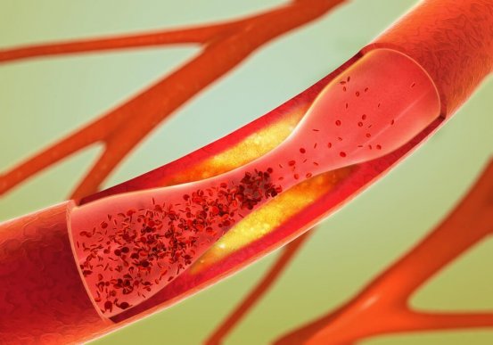 arteries-553x387