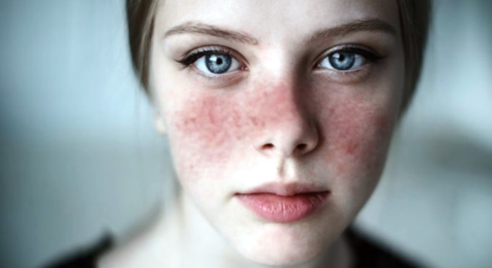lupus1