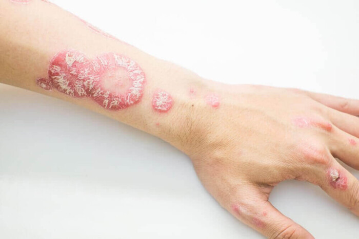 Psorias